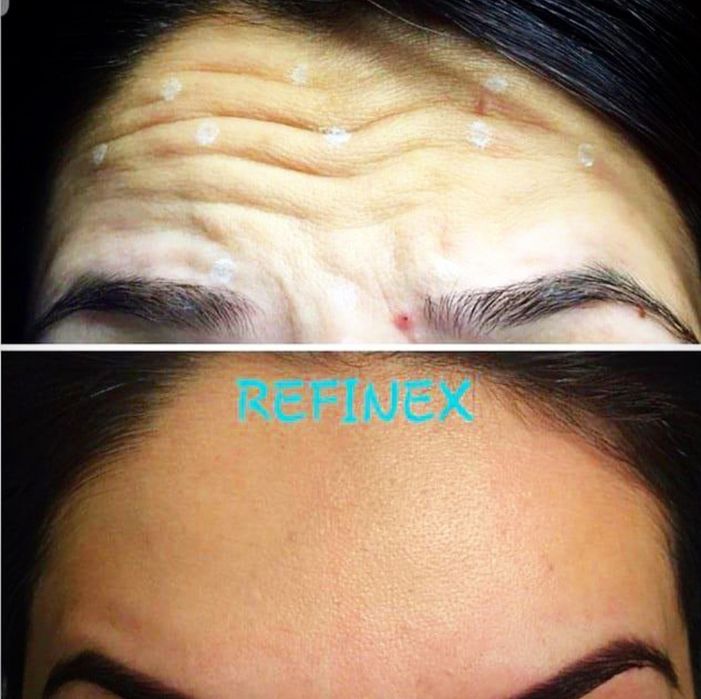 Botoks. Yuzdagi ajinlarni yuqotish ,