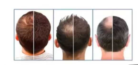 Шапка с червена светлина за 50%-100% повече окосмяване !