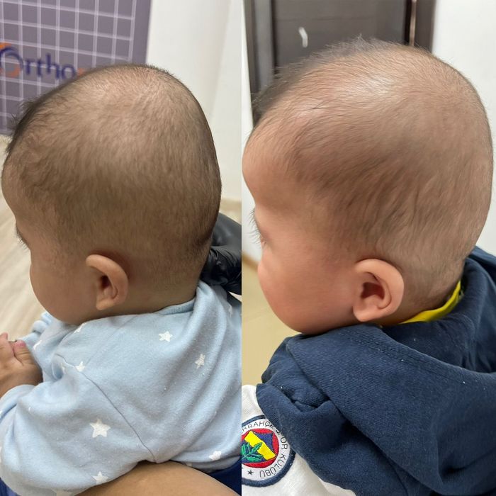 Ортопедическая каска (шлем)