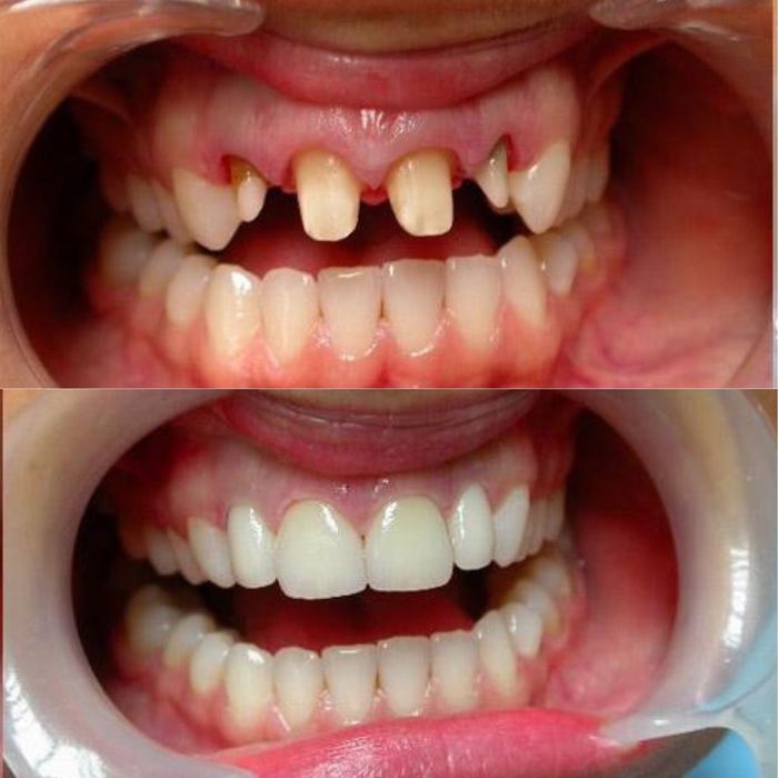 Металлокерамика . Зубные коронки.