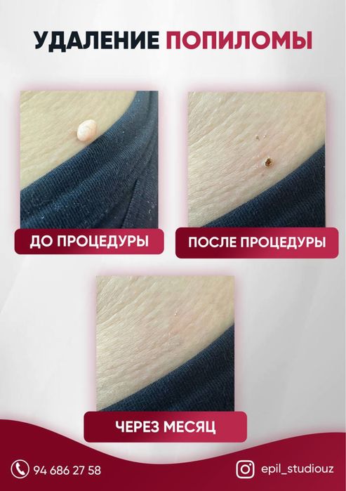 Удаление папиллом