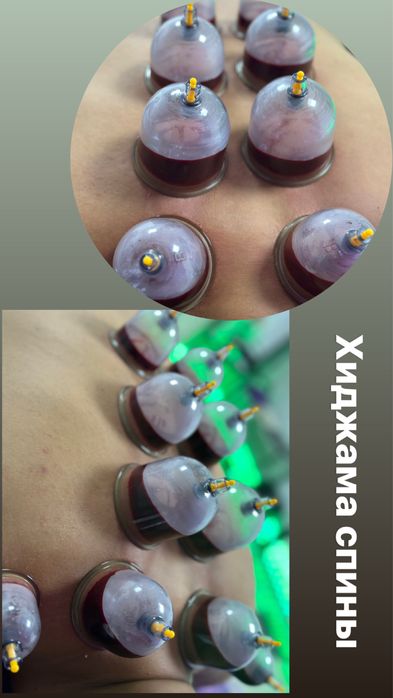 Оздоровительная хиджама