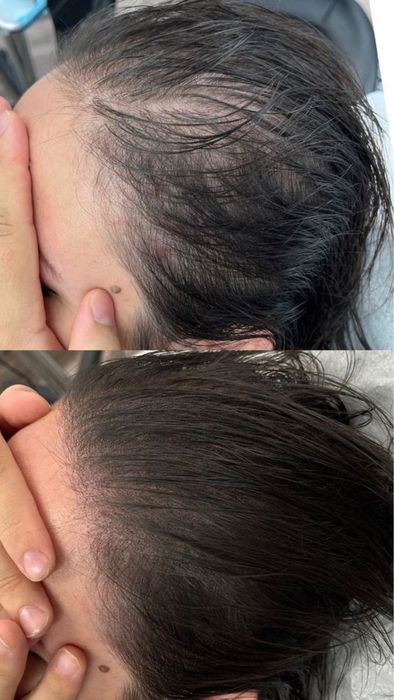 Soch tushishi yoki alopesiya bilan qiynalayapsizmi?Shifokor dermatolog