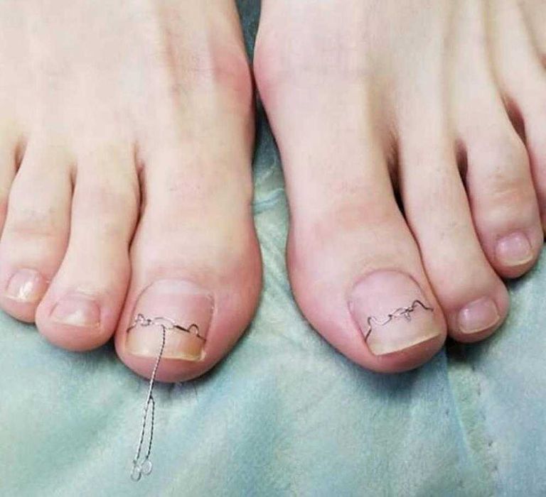 Пластина на ноготь фото Пластина на ноготь фото