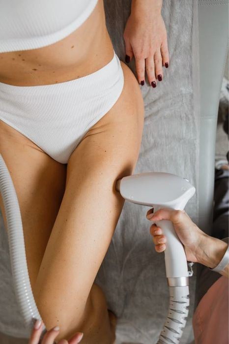 Лазерная эпиляция