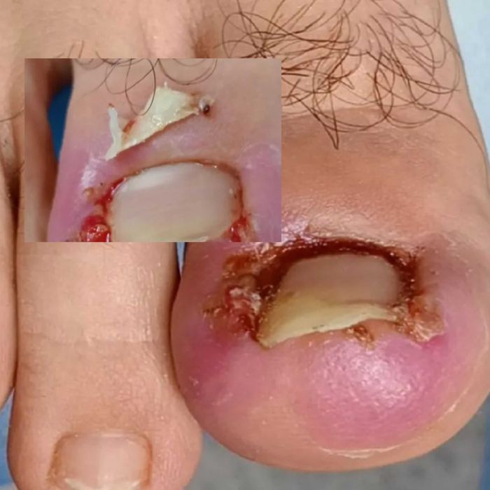 удаление вросшего ногтя