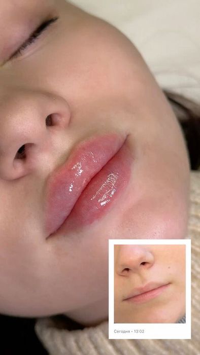 Лабга филлер ботекс