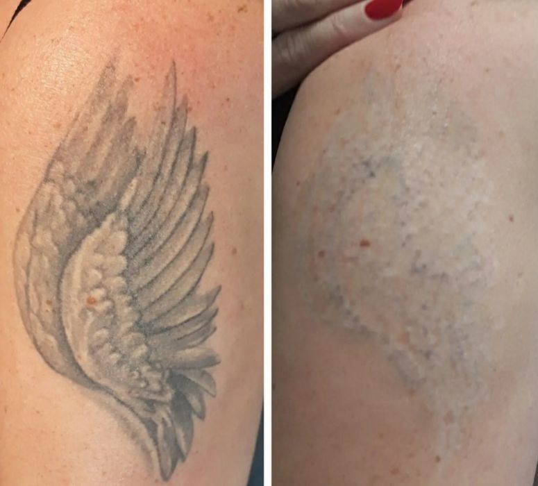 Nd YAG Удаление Татуажа и Татуировки! Мощный лазер!