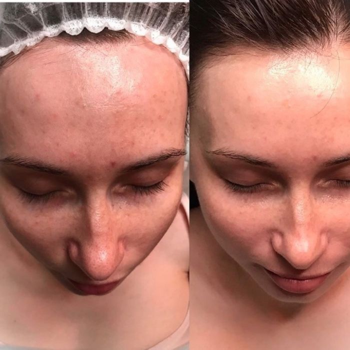 Чистка лица в Алматы