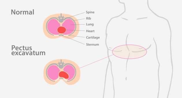 Orteza corectoare PECTUS EXCAVATUM