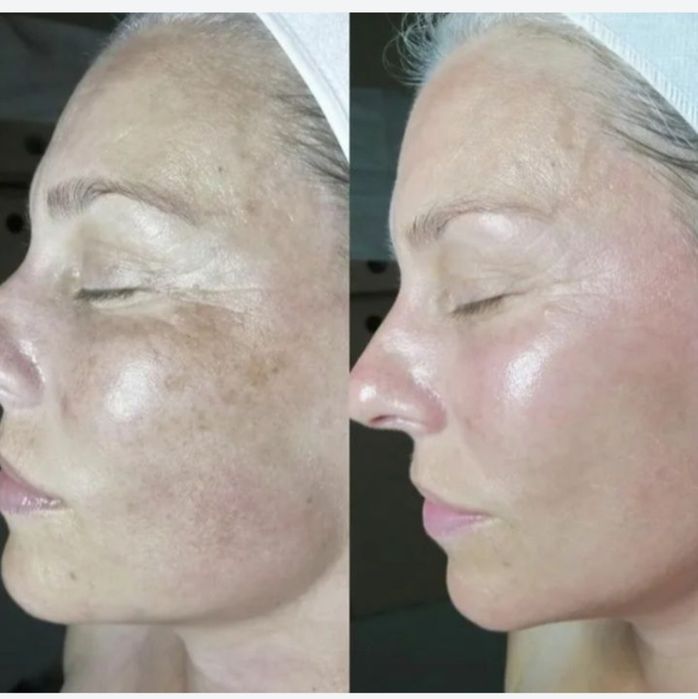 Удаление лазером тату от 5000, карбоновый пилинг 7000