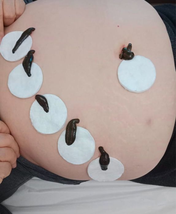 Лечение пиявками . Обучение