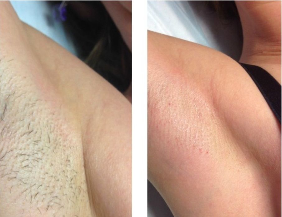 Услуга депиляции качественно и дёшова.