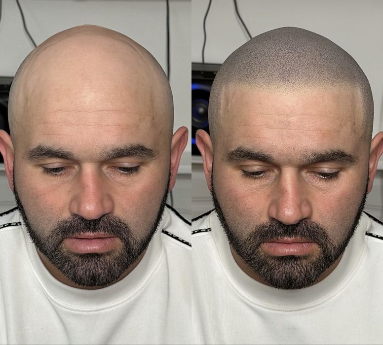 Micropigmentare scalp si barba indesire par tatuaj alopecie chelie