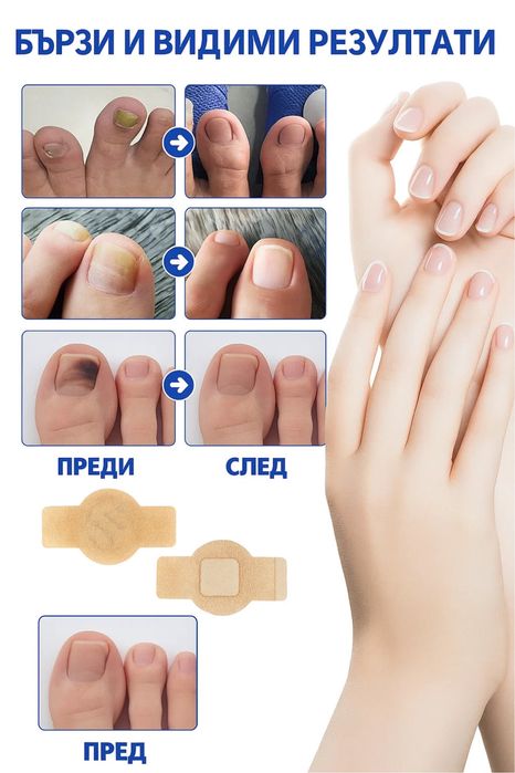 Лепенки против гъбички по ноктите