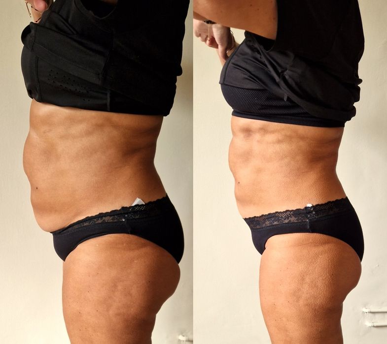 Remodelare cu ultrasunet - LipoSlim & HIFU