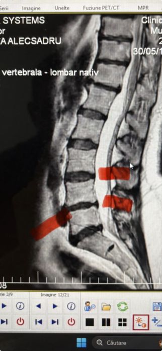 Recuperare la domiciliu - Kinetoterapie AVC - Hernie de disc - Protezare - Scolioză - Cifoza - Umar dureros