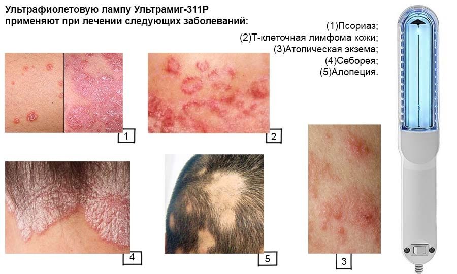 Облучатель ультрафиолетовый для лечения псориаза витилиго
