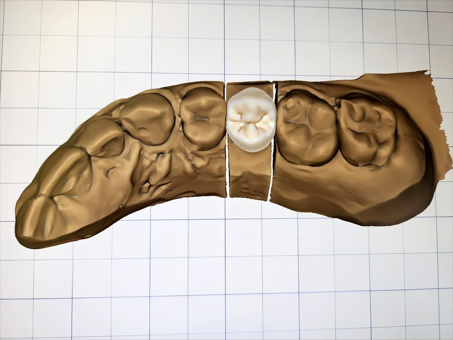 Дигитален Дизайн на Зъбопротезни конструкции от Зъботехник чрез Exocad