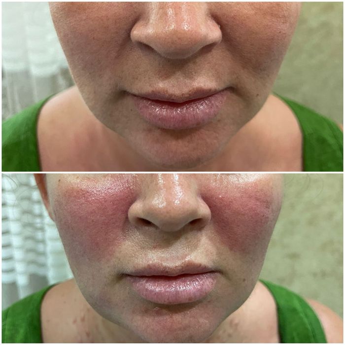 Косметологические услуги (мужчины и женщины) ,фуллфейз ботокс, губы