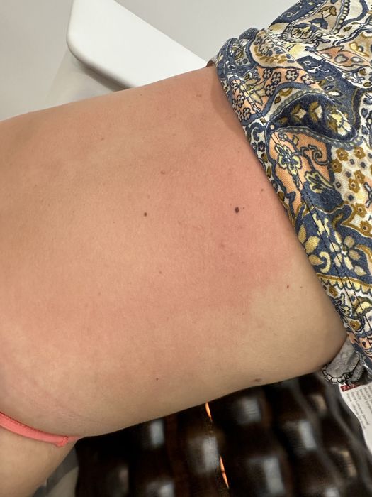 Masaj anticelulitic 100lei / sedinta/1h