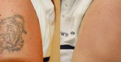 Удаление татуировок. Лазерное удаление татуировки в Ташкенте.