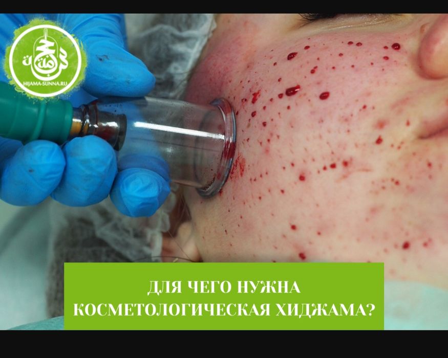 Хиджама Косметологическая