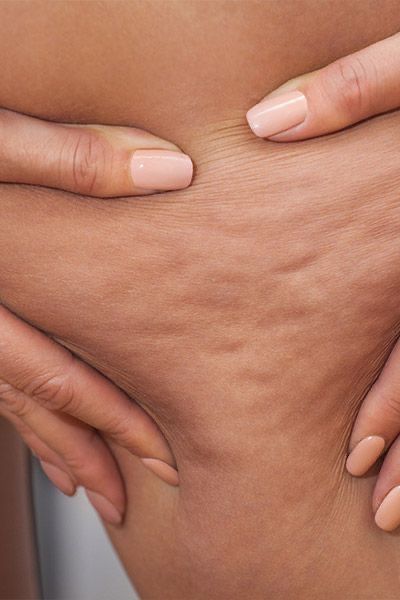 Антицеллюлитный массаж