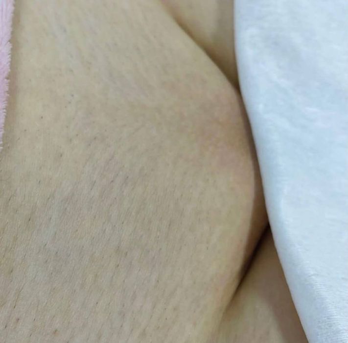 Лазерная эпиляция/Удаление татуажа