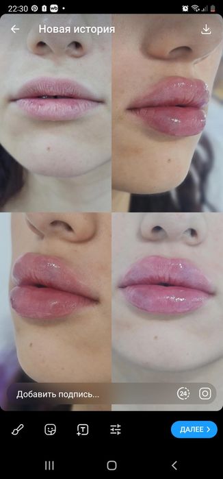 Губки , филлер, ботокс . Качественно!