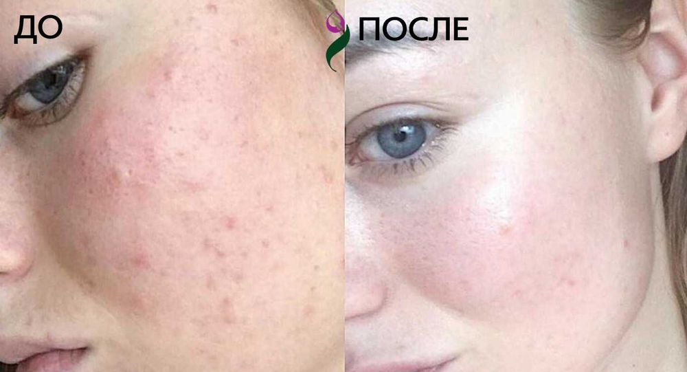 Плазмолифтинг, Plazmolifting в косметологии. Плазмотерапия.