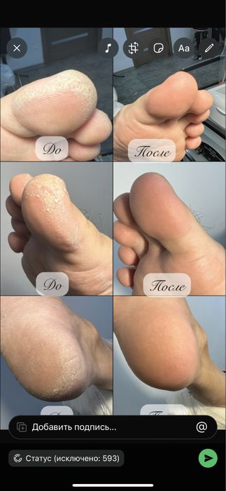 Педикюр, чистка стоп, ногтей