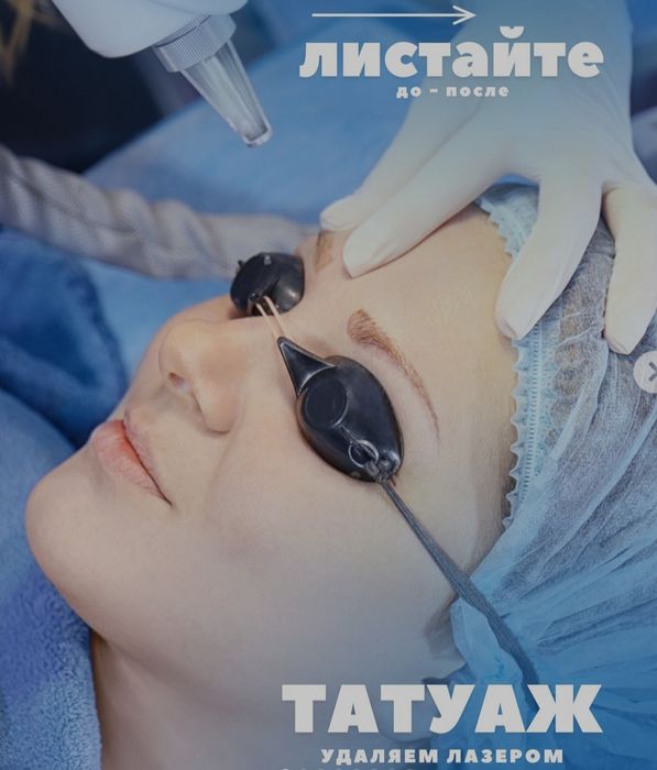 Удаление тату лазером