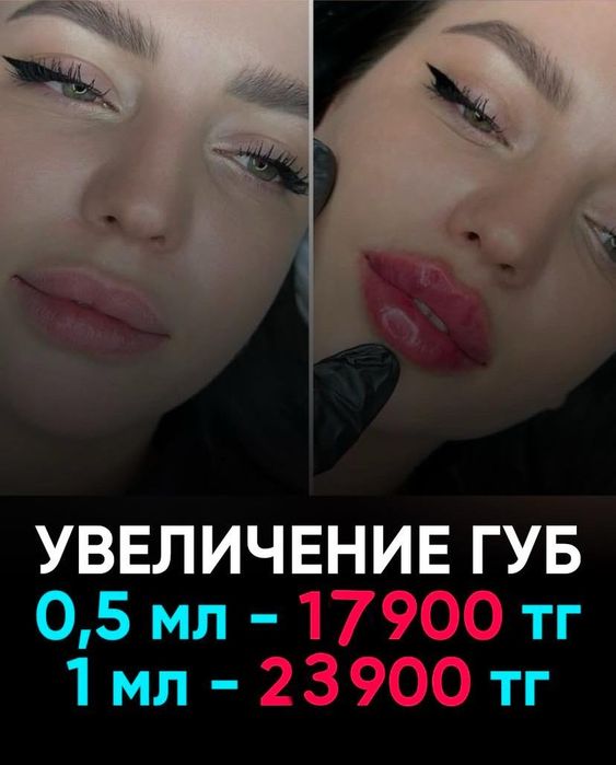 Увеличение губ от 17900
