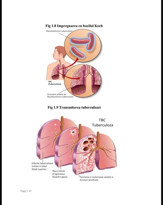 Licenta AMG 2023 îngrijirea pacientului cu tuberculoză pulmonară
