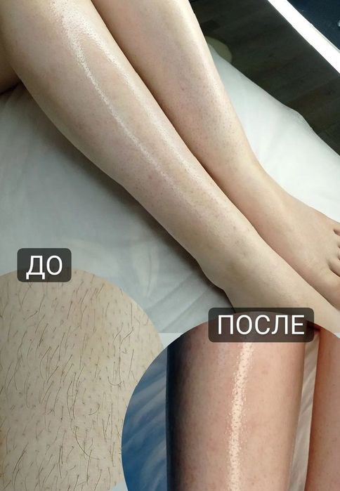 Лазерный Эпилятор