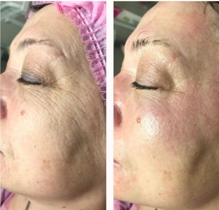 Королевский пилинг. Hydra Royal