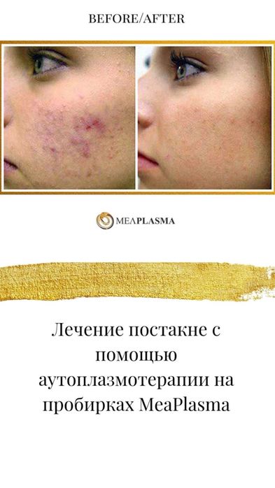 Обучение Меаплазма