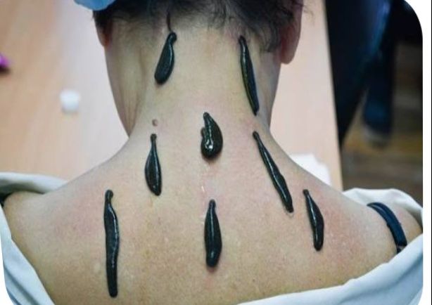 Пиявки лечение сертификат