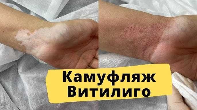 Vitiligo kamuflyaji
