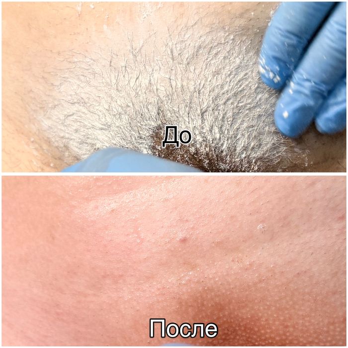 Шугаринг Депиляция