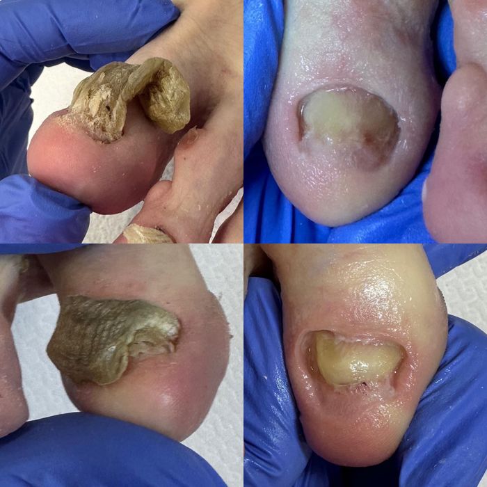 Pedichiură Medicală