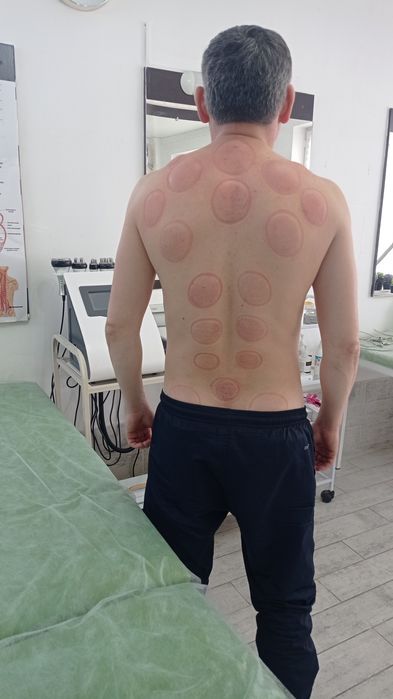 хиджама, массаж, диагностика, иглотерапия