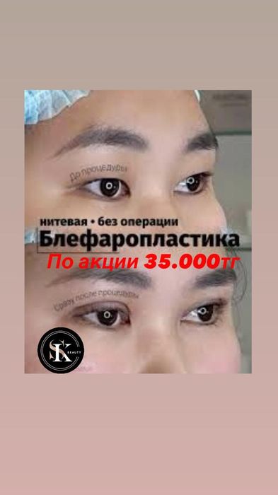 Нитевая блефаропласиика