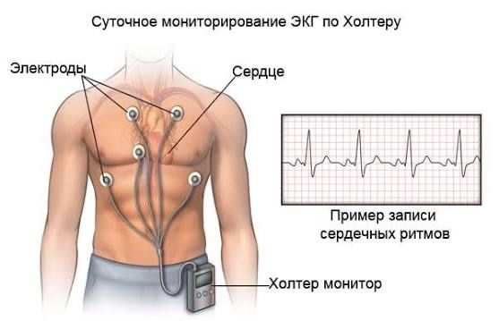 Холтер экг мониторирования на дому