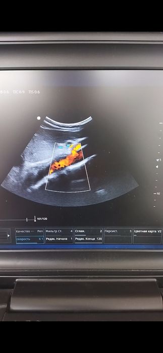 УЗИ аппарат портатив