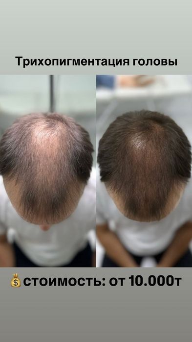 Трихопедментация головы