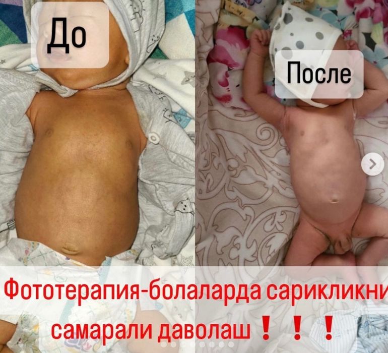 Fotolampa chaqaloqlardagi sariqlikni yo'qotish uchun fototetapiya