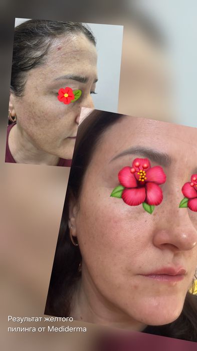 Косметолог.  Чистка лица