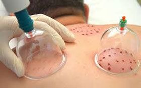 Хиджама в Каскелене